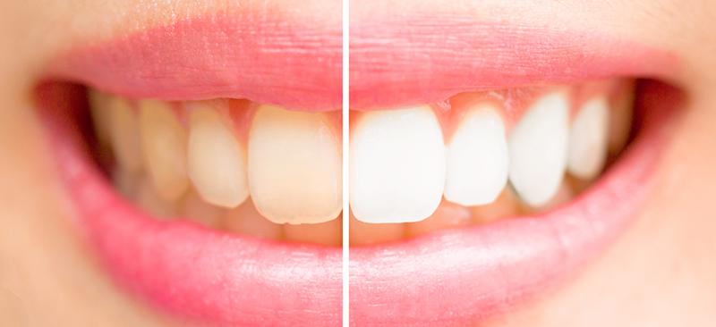 How to remove coffee deals stains from teeth